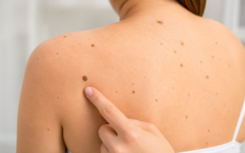 Cáncer de piel: cuatro señales de alerta en lunares y manchas que no debes ignorar